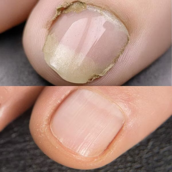 IZA Effect Anti Fuß- & Nagelpilz Spray 1+1 GRATIS