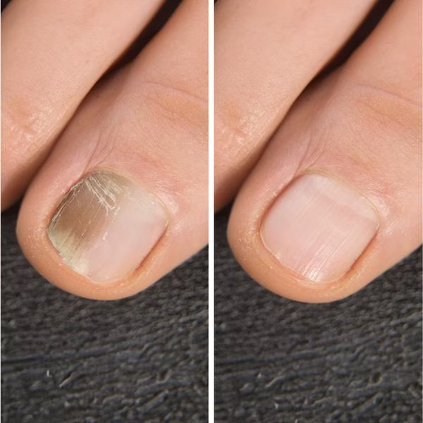 IZA Effect Anti Fuß- & Nagelpilz Spray 1+1 GRATIS
